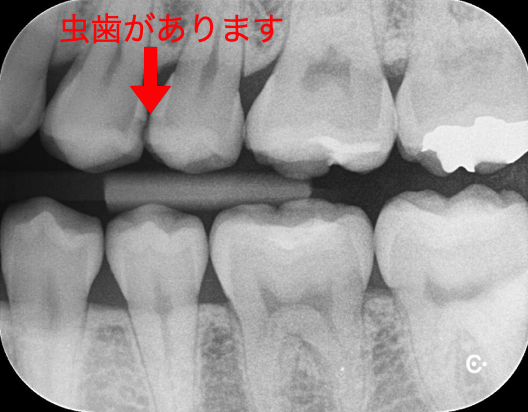 虫歯治療 ２