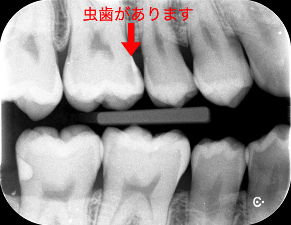 虫歯治療 １