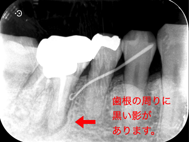 再根管治療（根尖性歯周炎の治療） ２
