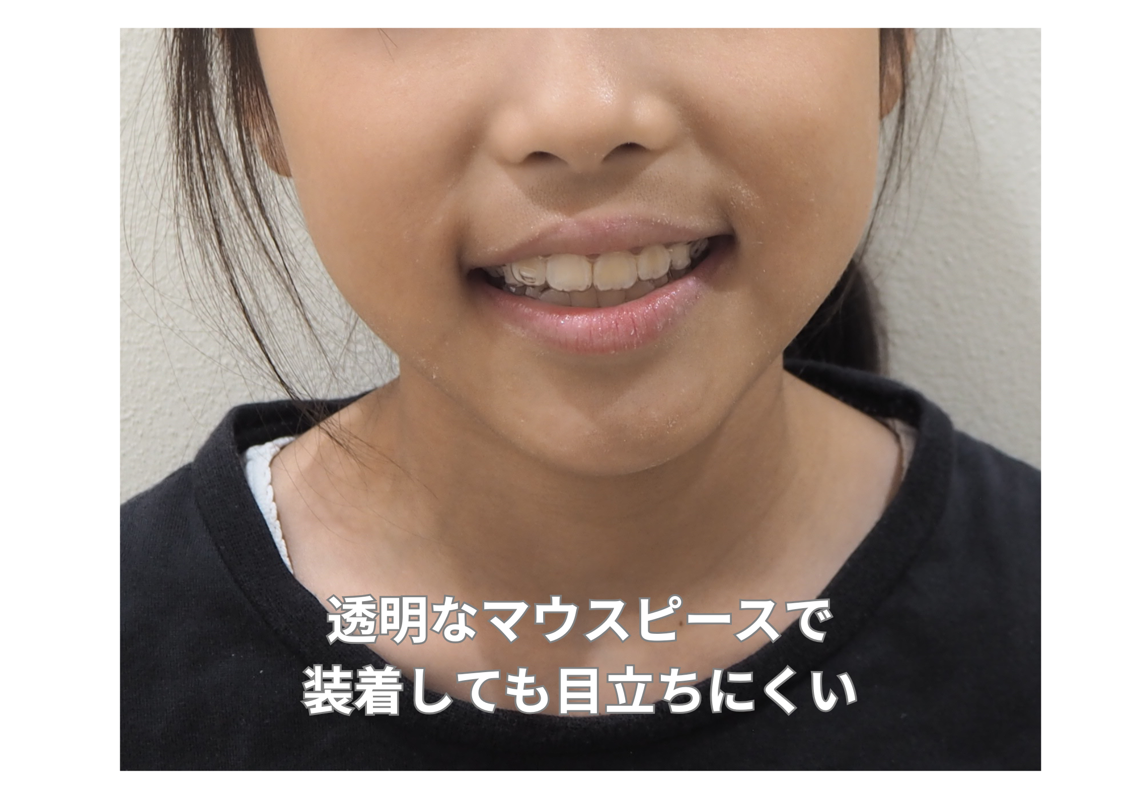 小児矯正(マウスピース矯正)に力を入れてます