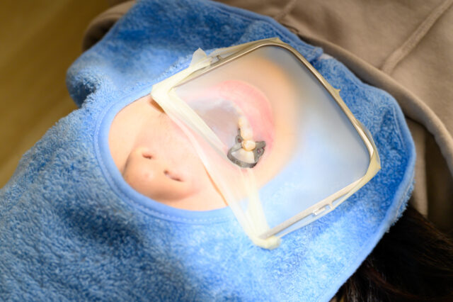 歯の神経の治療（根管治療）の際には、全ての治療でラバーダムを使用します。